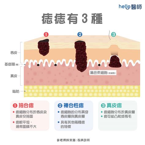 長毛痣|皮膚長痣、長斑是皮膚癌前兆？皮膚癌初期4大症狀快。